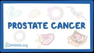 Prostate cancer
