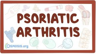 Psoriatic arthritis – causes, symptoms, diagnosis, treatment, pathology