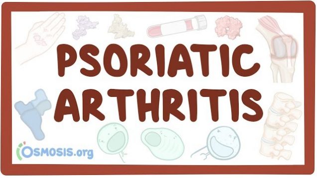 Psoriatic arthritis – causes, symptoms, diagnosis, treatment, pathology
