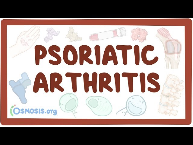 Psoriatic arthritis - causes, symptoms, diagnosis, treatment, pathology