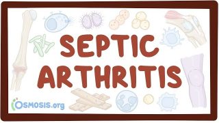 Septic arthritis – causes, symptoms, diagnosis, treatment, pathology