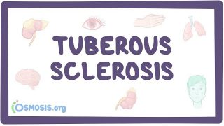 Tuberous sclerosis