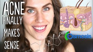 Acne vulgaris – causes, symptoms, diagnosis, treatment, pathology