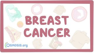 Breast Cancer – causes, symptoms, diagnosis, treatment, pathology
