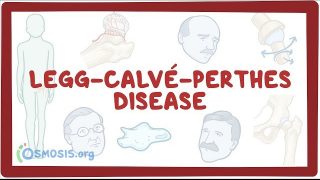 Legg-Calve-Perthes disease