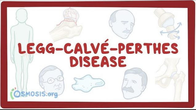 Legg-Calve-Perthes disease