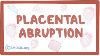 Placental abruption – causes, symptoms, diagnosis, treatment, pathology