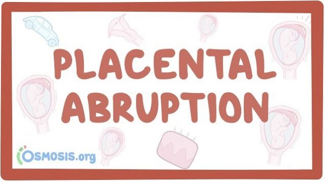 Placental abruption – causes, symptoms, diagnosis, treatment, pathology
