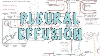 Pleural Effusion (DETAILED) – (pathophysiology, signs and symptoms, treatment)