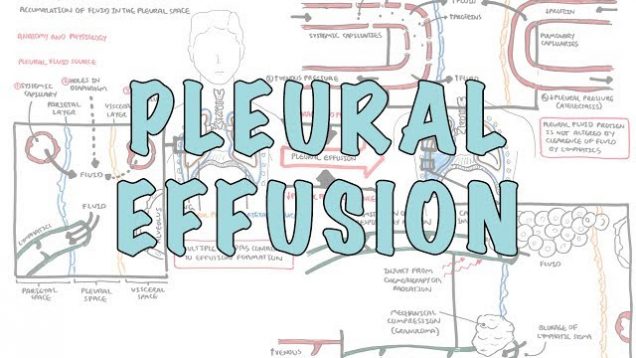 Pleural Effusion (DETAILED) – (pathophysiology, signs and symptoms, treatment)