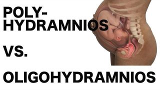 Polyhydramnios vs. Oligohydramnios