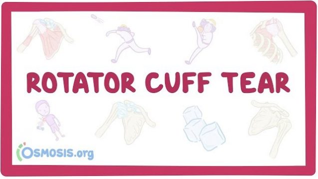 Rotator cuff tears