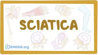 Sciatica – causes, symptoms, diagnosis, treatment, pathology