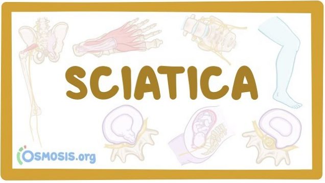 Sciatica – causes, symptoms, diagnosis, treatment, pathology