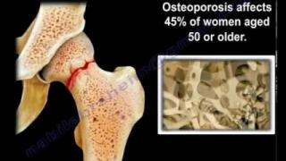 Osteoporosis – Everything You Need To Know – Dr. Nabil Ebraheim