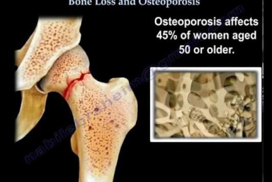 Osteoporosis – Everything You Need To Know – Dr. Nabil Ebraheim
