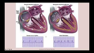 Flutters and Fibrillations – CRASH! Medical Review Series