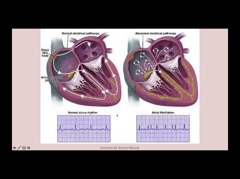 Flutters and Fibrillations – CRASH! Medical Review Series