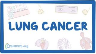 Lung cancer – causes, symptoms, diagnosis, treatment, pathology