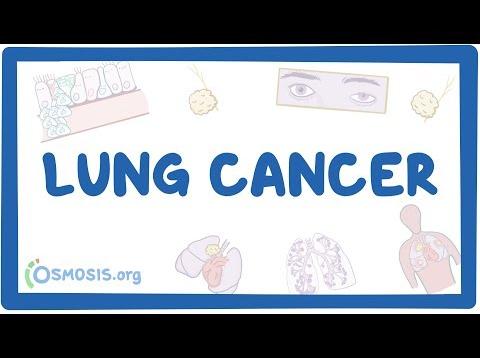 Lung cancer – causes, symptoms, diagnosis, treatment, pathology