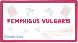 Pemphigus vulgaris