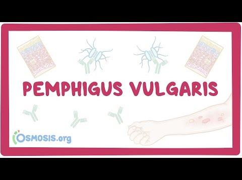 Pemphigus vulgaris