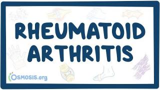 Rheumatoid arthritis – causes, symptoms, diagnosis, treatment, pathology