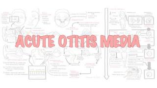 Acute Otitis Media (Causes, Pathophysiology, signs and symptoms, treatment and complications)