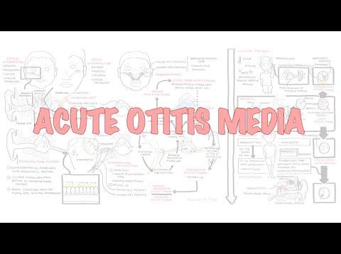 Acute Otitis Media (Causes, Pathophysiology, signs and symptoms, treatment and complications)
