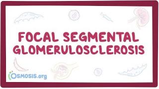 Focal segmental glomerulosclerosis – causes, symptoms, diagnosis & pathology