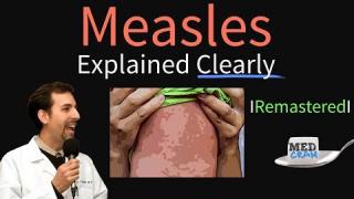 Measles Symptoms, Diagnosis, Vaccine, Treatment Explained Clearly – Remastered