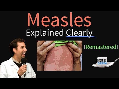 Measles Symptoms, Diagnosis, Vaccine, Treatment Explained Clearly – Remastered