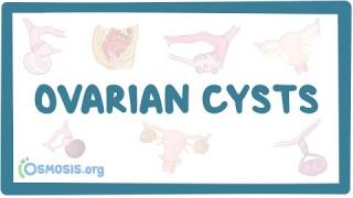 Ovarian cyst- causes, symptoms, diagnosis, treatment, pathology