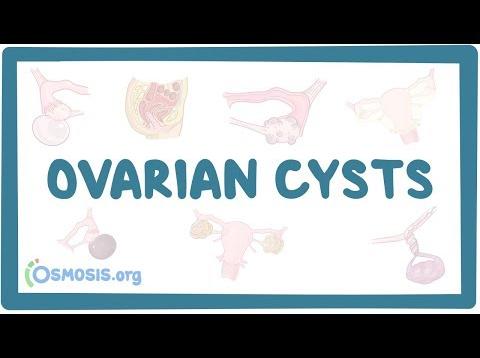 Ovarian cyst- causes, symptoms, diagnosis, treatment, pathology
