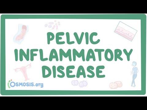Pelvic inflammatory disease – causes, symptoms, diagnosis, treatment, pathology