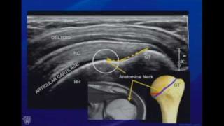 Ultrasound of the Shoulder