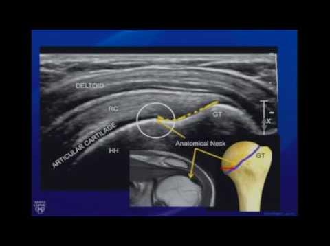 Ultrasound of the Shoulder