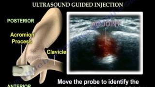 Shoulder Pain Injection, AC Joint – Everthing You Need To Know – Dr. Nabil Ebraheim