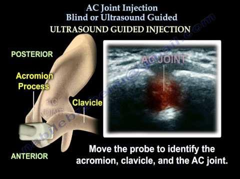 Shoulder Pain Injection, AC Joint – Everthing You Need To Know – Dr. Nabil Ebraheim