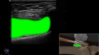 3D How to: Ultrasound Guided Injection of the Lateral Knee – SonoSite Ultrasound