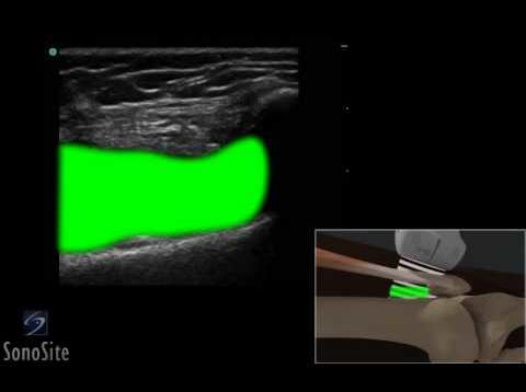 3D How to: Ultrasound Guided Injection of the Lateral Knee – SonoSite Ultrasound