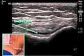 How to: Ultrasound Guided Knee Injection