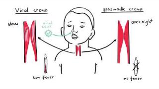 What is Croup (larynotracheobronchitis) – symptoms, pathophysiology, investigations, treatment