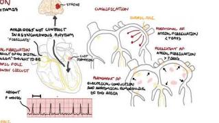 Atrial Fibrillation Overview – ECG, types, pathophysiology, treatment, complications