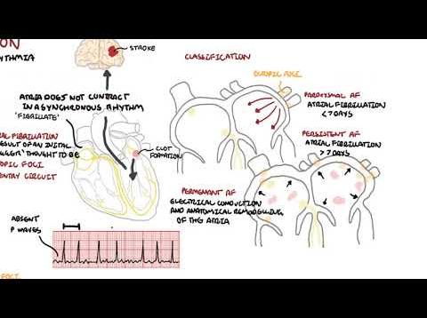 Atrial Fibrillation Overview – ECG, types, pathophysiology, treatment, complications