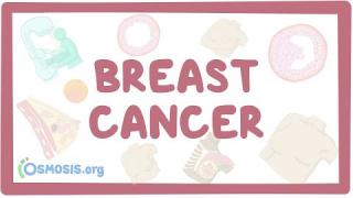 Breast cancer – causes, symptoms, diagnosis, treatment, pathology