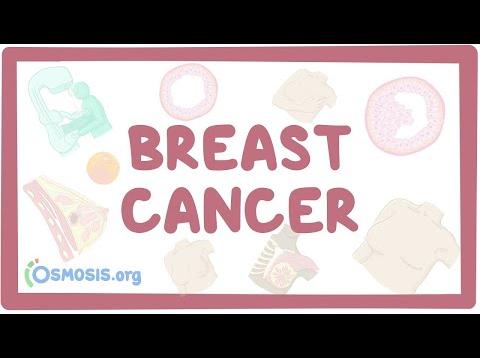 Breast cancer – causes, symptoms, diagnosis, treatment, pathology