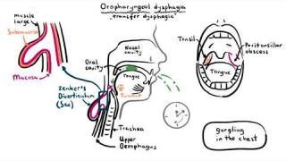 Dysphagia (difficulty swallowing) – causes, pathophysiology, classification, investigation