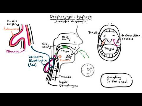 Dysphagia (difficulty Swallowing) - Causes, Pathophysiology ...