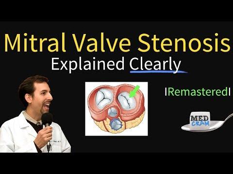 Mitral Valve Stenosis: Diagnosis, Treatment, Pathophysiology